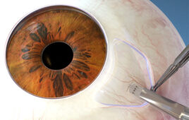 An illustration showing implantation of the Myra Vision Calibreye device for glaucoma, which uses shape memory nitinol.