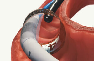 An illustration of the The Endogenex ReCET catheter's canister and its polyurethane wings.