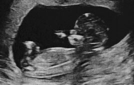 A stock photo of a fetal ultrasound.