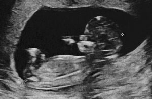 A stock photo of a fetal ultrasound.