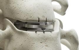 A close up image of Synergy Disc implanted in the cervical spine.