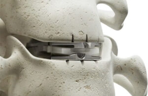 A close up image of Synergy Disc implanted in the cervical spine.