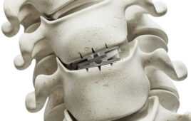 Synergy Disc implanted in a spine.
