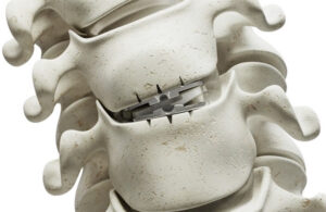 Synergy Disc implanted in a spine.