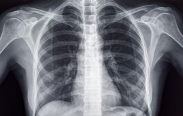 An image of a chest X-ray.
