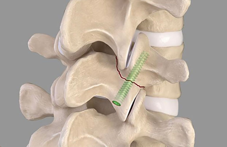 An illustration of Arthrex's Percutaneous Pars Fracture Compression Screw.