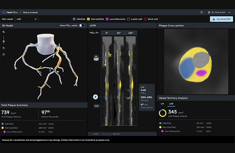 An image of Heartflow's Heartflow Next Generation Heartflow Plaque Analysis technology.