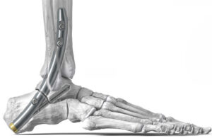 An illustration of the Paragon 28's curved TTC implant.