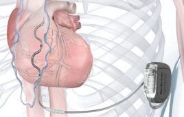 An illustration of the Medtronic Aurora EV-ICD system implanted in a patient's chest.