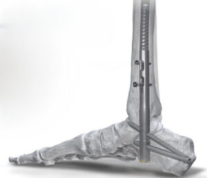 An illustration of Paragon 28's traditional Phantom Hindfoot TTC nail system with a straight implant.