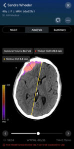 A photo of Viz.ai's Viz Hemorrhage mobile app.