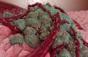 An illustration of New Phase's Sarah Nanoparticles attaching to a tumor.