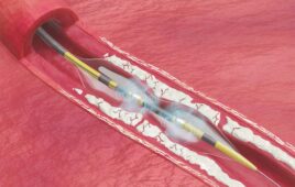 An illustration of the Shockwave Medical C2 Aero IVL catheter breaking up arterial calcium. [Illustration courtesy of Johnson & Johnson MedTech]