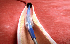 An illustration of the Anchor Balloon AngioLock being used in a patient.