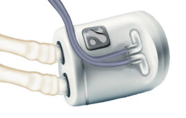 An illustration depicting the Nephrodite Holly implantable system for continuous dialysis.