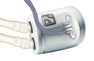 An illustration depicting the Nephrodite Holly implantable system for continuous dialysis.