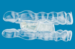 A photo of Align Technology's Invisalign orthodontic treatment.