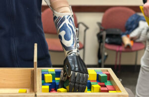 An image of a patient using a Metacarpal GEM prosthetic hand.