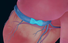 An illustration of VahatiCor's A-Flux implant situated in the coronary sinus.