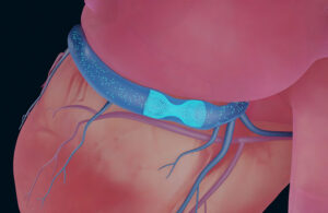 An illustration of VahatiCor's A-Flux implant situated in the coronary sinus.