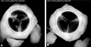 A radiographic image of an Edwards Lifesciences Resilia tissue valve compared to a control valve.