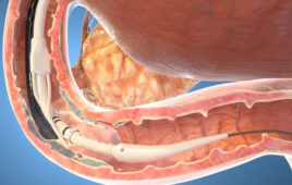 An illustration of Fractyl Health's Revita system in using ablation in the dueodenum.