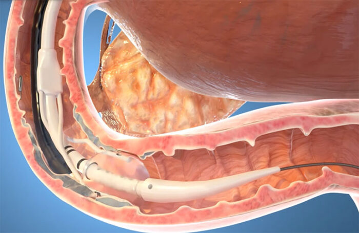 An illustration of Fractyl Health's Revita system in using ablation in the dueodenum.