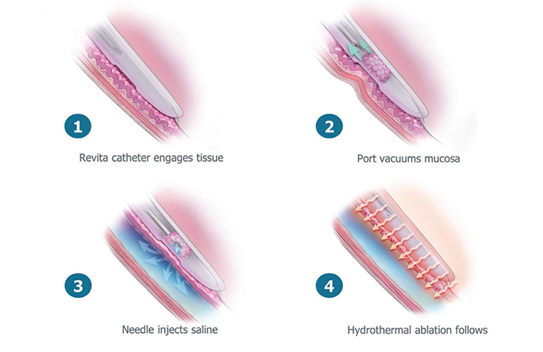An illustration showing a Revita procedure process to inject saline in the duodenum to protect the muscle.