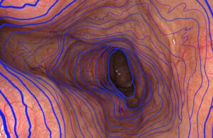 An illustration showing Lambda Surgical's LiDAR tech at use inside the human body.
