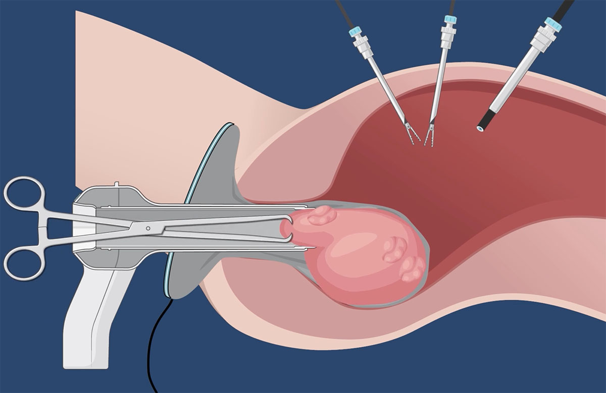 An illustration depicting the extraction of a uterus using the minimally invasive Claria Medical system.