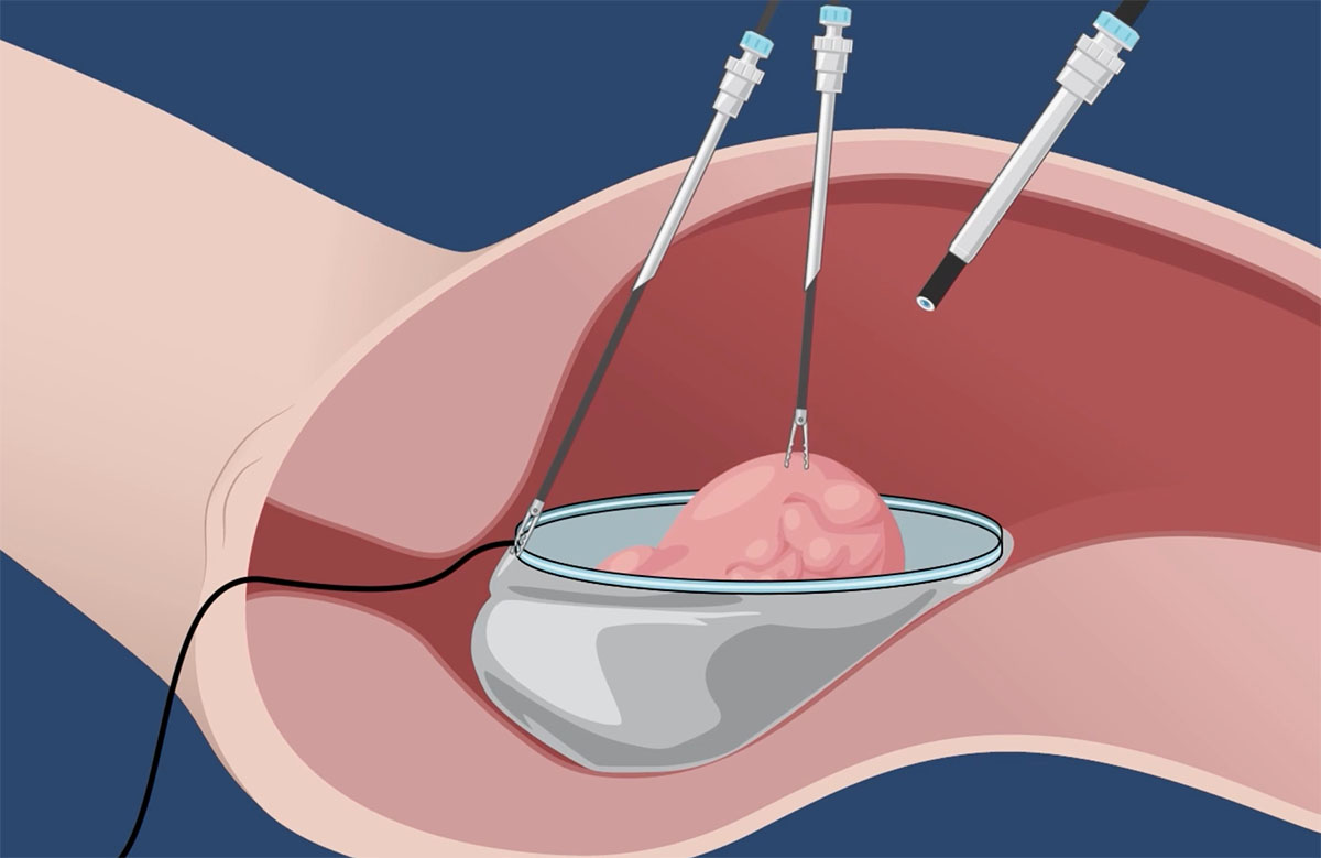 An illustration depicting the first step of a minimally invasive hysterectomy using Claria Medical's system.