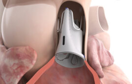 A heart valve that grows with children shows what pediatric devices can become