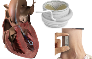 Clockwise from the left, Johnson & Johnson MedTech's Impella CP pump, Edwards Lifesciences' Sapien M3 TMVR, and Medtronic's Altaviva urinary incontinence implant — all which could be considered as most innovative medical devices of 2026 as they are nominees for Prix Galien awards.